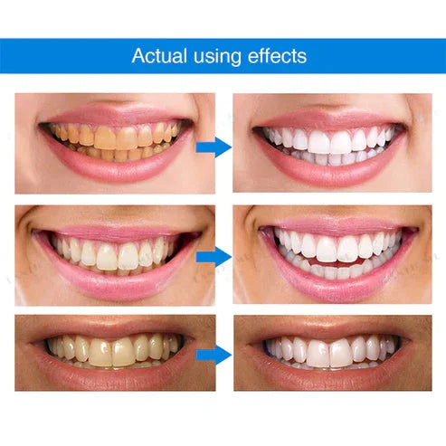 🔥 Promotion 49% OFF🔥-Teeth Whitening Essence